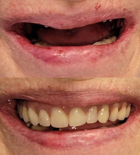 Dentures