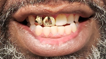 Gold Crowns