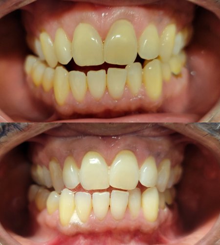 Befre and After