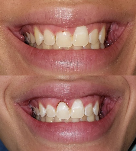Befre and After