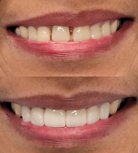 Befre and After